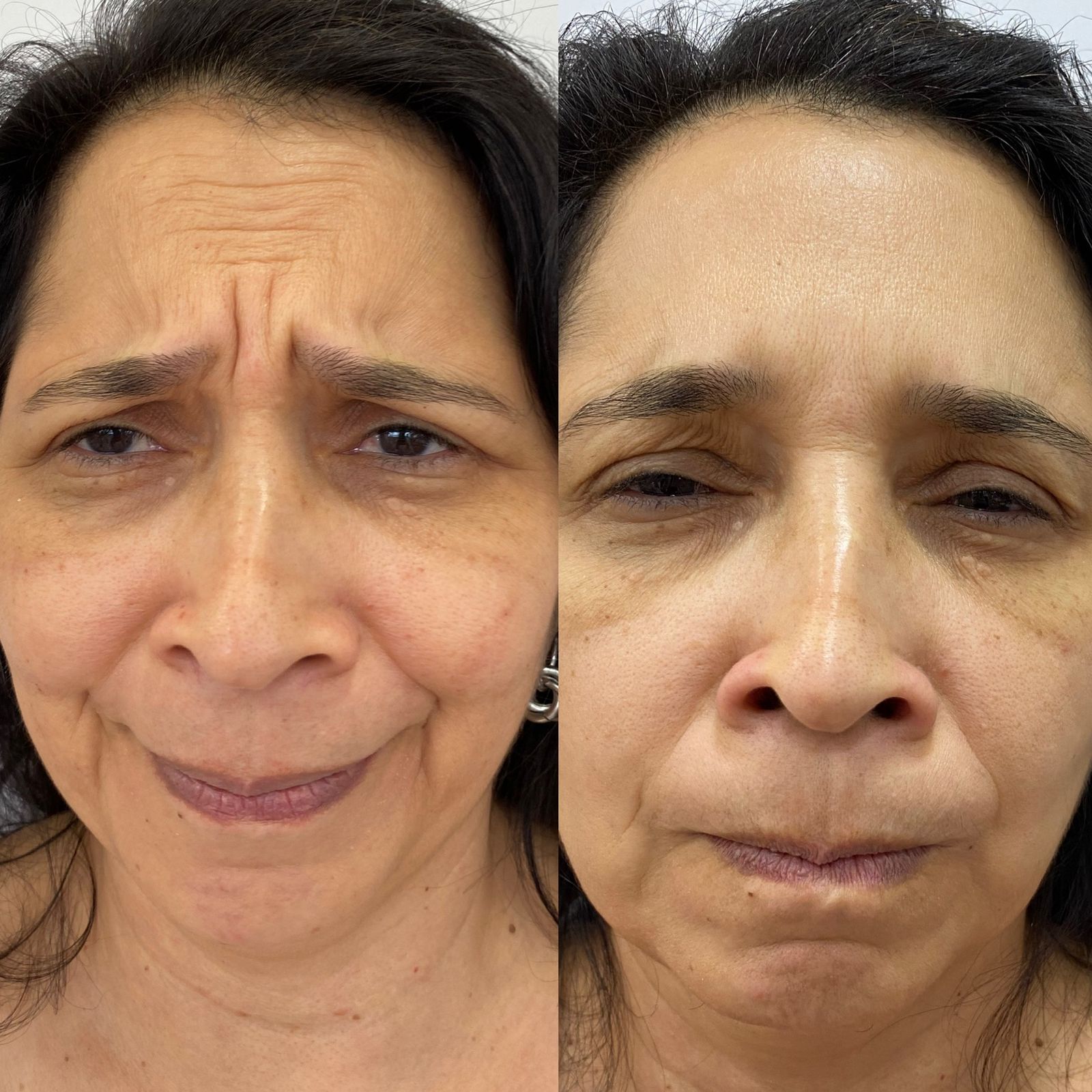 Dra. Milagros Abras Botox #3.2
