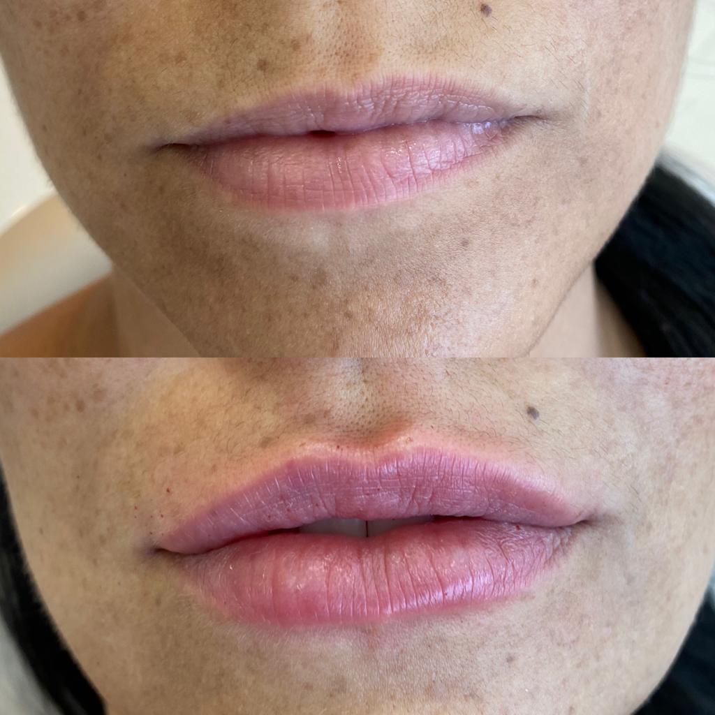 Dra. Milagros Abras Preenchimento Labial #3